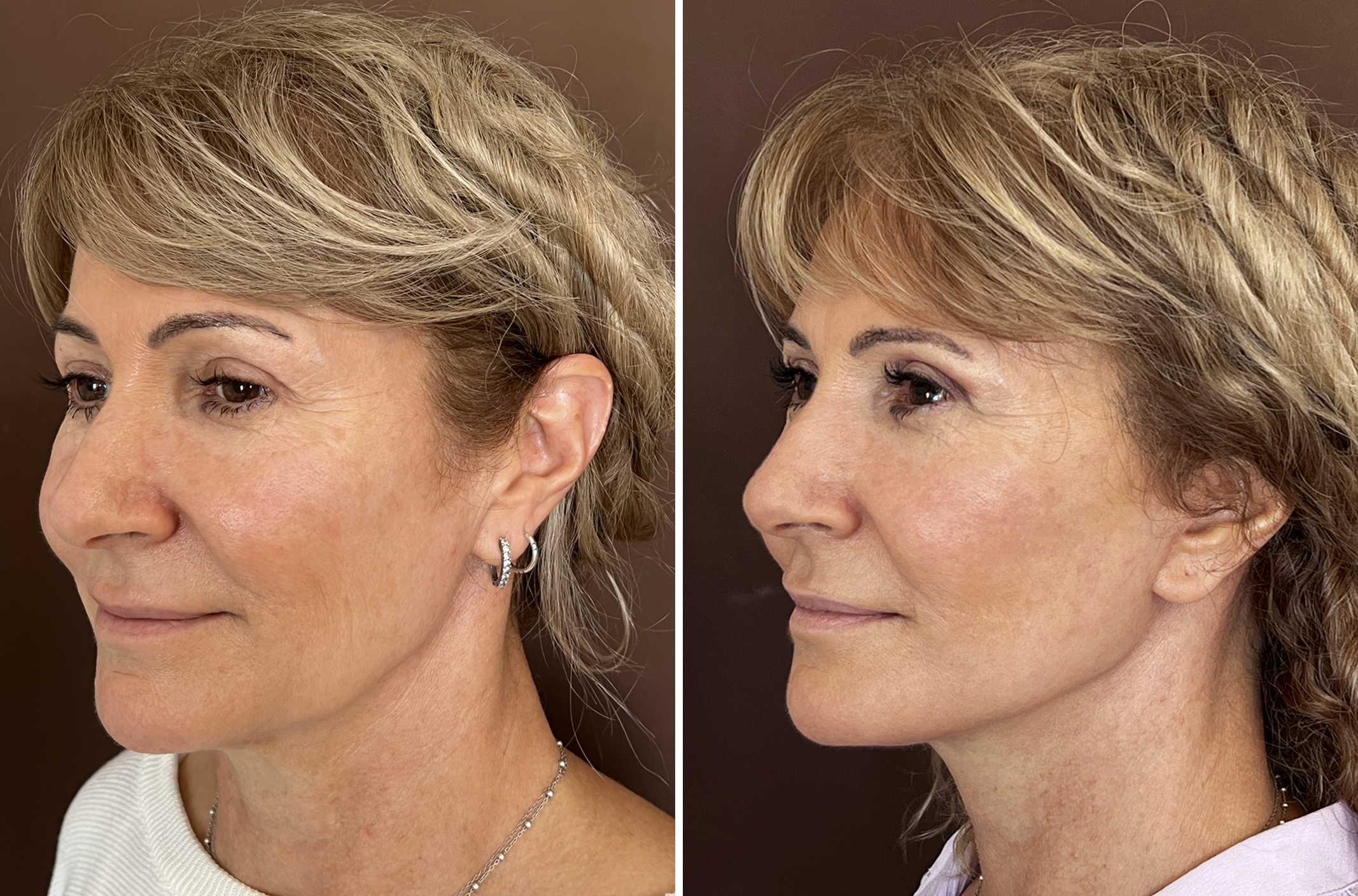 Caso Lifting Deep Plane — vista de perfil, resultado antes y después