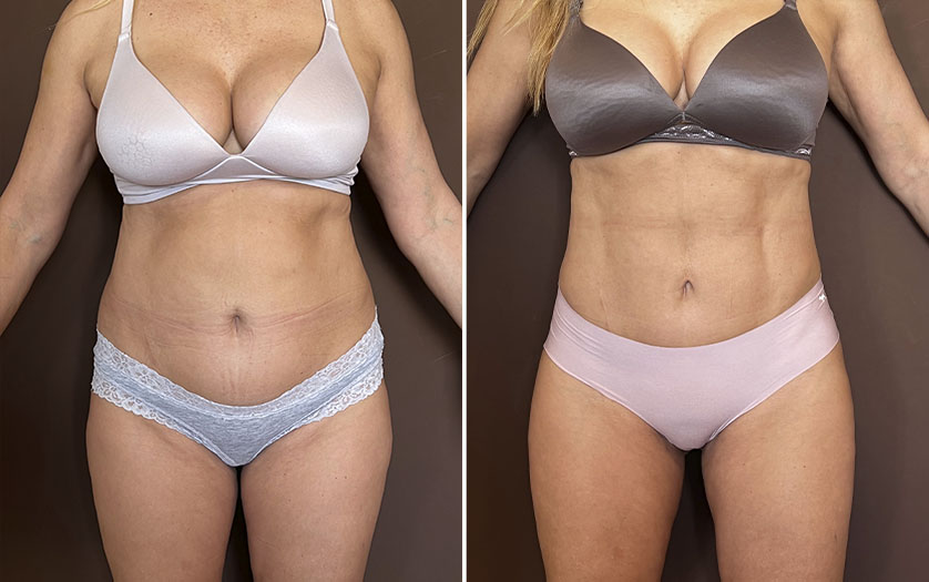 Liposucción HD con tecnología Renuvion