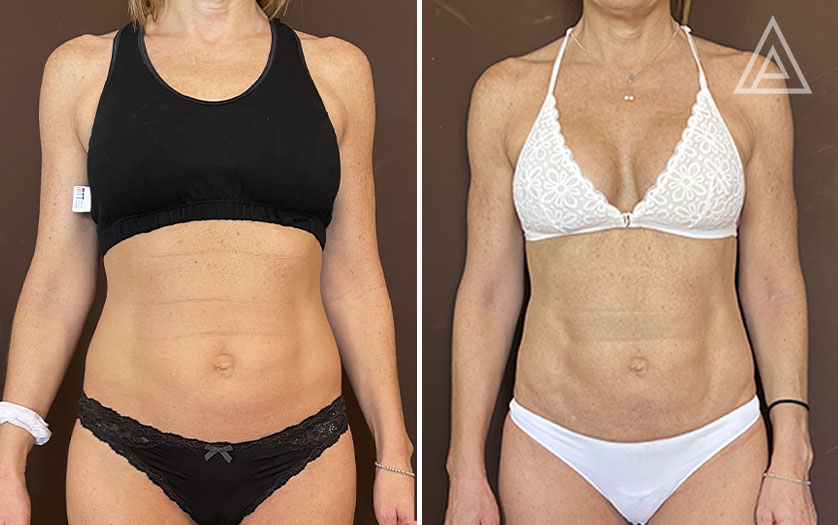 Liposucción HD con tecnología Renuvion