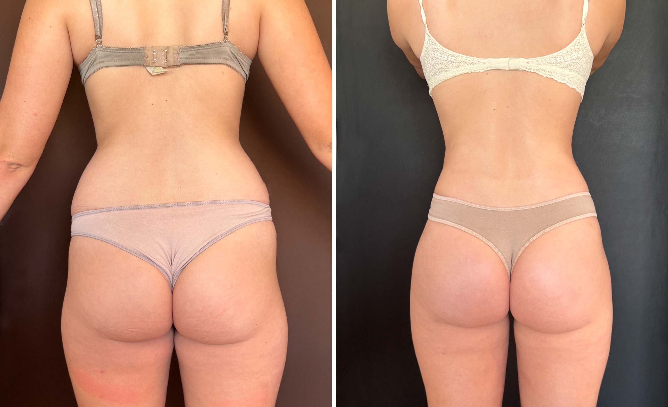 caso-lipo-espalda-2025