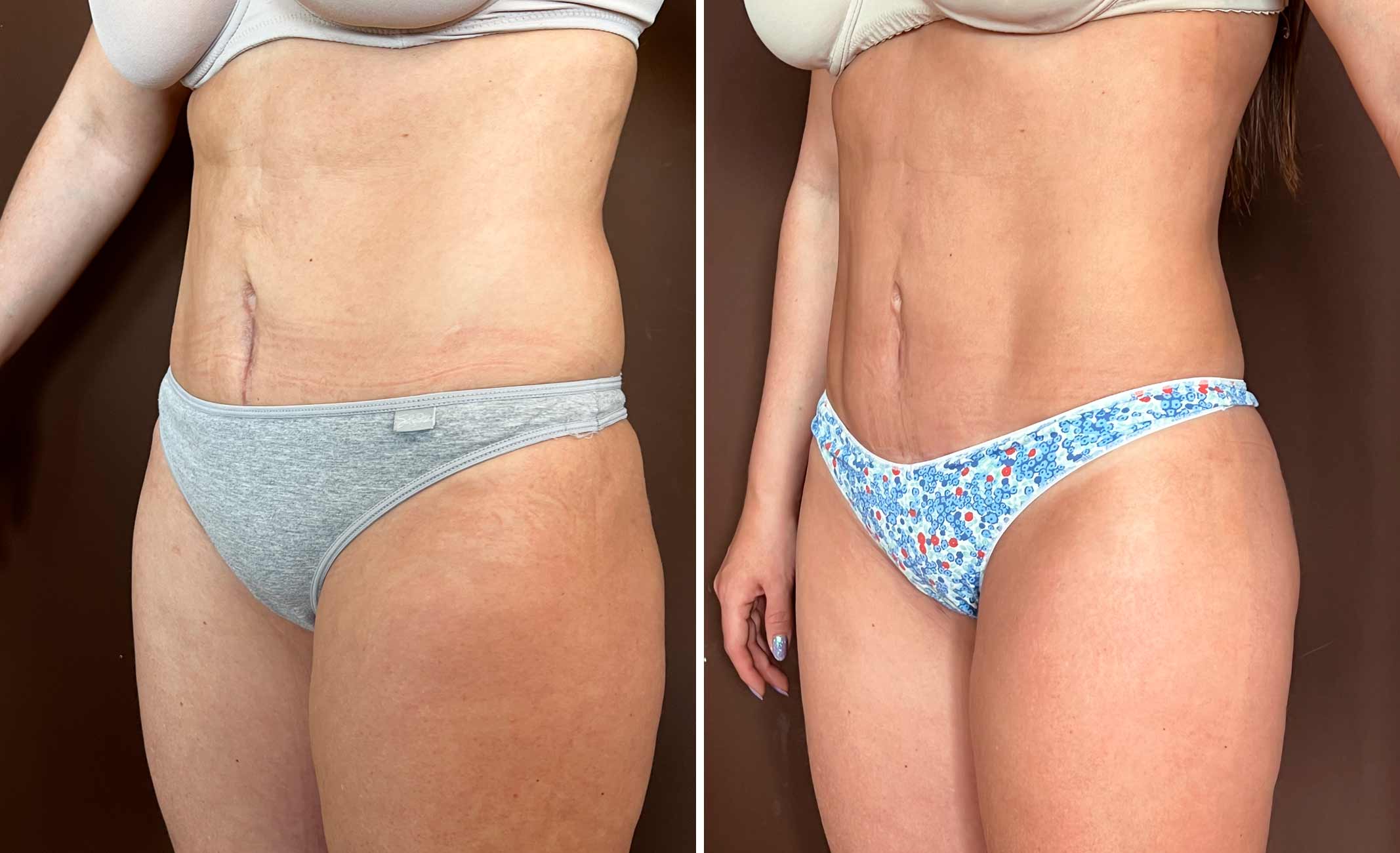 lipo-Renuvion-echaide-2