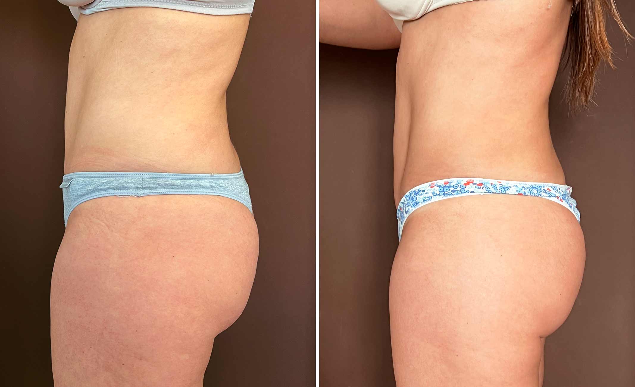 lipo-Renuvion-echaide-3