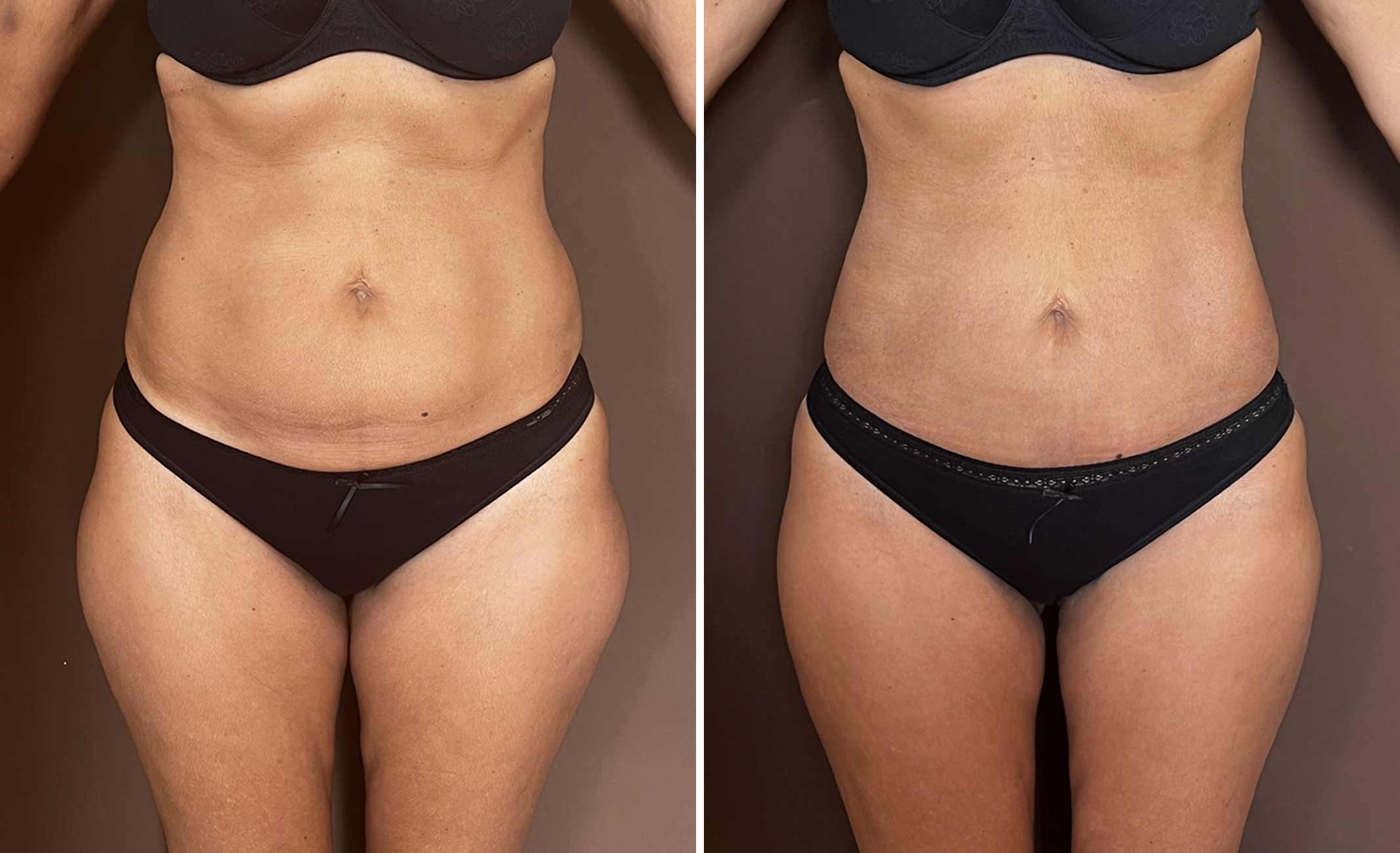 lipo-Renuvion-iribarne